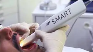 Escaneamento Intraroal - Smart Aligner
