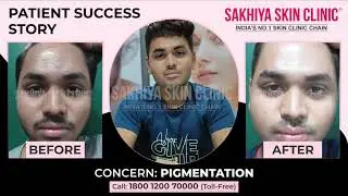 Pigmentation Treatment Success Story | Real Patient Review | Sakhiya Skin Clinic