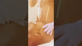 ProFractional Laser at Spa26