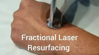 Fractional Laser for hands rejuvenation.