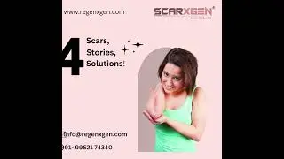 Silicone Gel Sheets for Scar Removal &ndash; Effective Scar Treatment Solution!