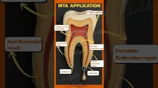 MTA #dentist #daantologytales #endodontics #teeth #rct #new #dentalcare #science #mta #save