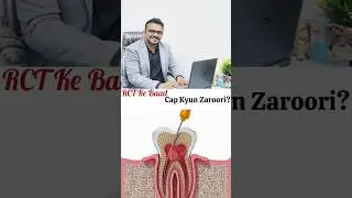 Importance of Capping After Root Canal &ndash; RCT Ke Baad Cap Kyun Zaroori Hai?