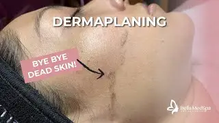 FULL DERMAPLANING TREATMENT
