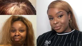 Balding Frontal Wig Cover Up