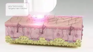 Motif Hair Removal Patient Waiting Room Video