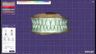 FMR - designing in exocad for pmma prosthesis