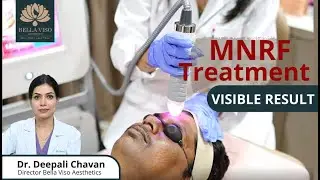 Live MNRF Skin Treatment | Real-Time Procedure for Glowing & Clear Skin