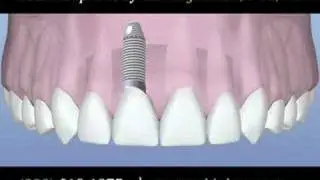 Need Dental Implants? Dr. Carl K. Johnson can help you! - Ma