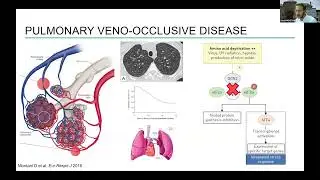 Genetic background and response to Sotatercept - Prof. David Montani