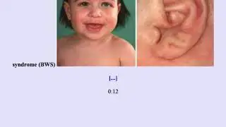 Wilm's Tumor Nephroblastoma - USMLE Step 2CK