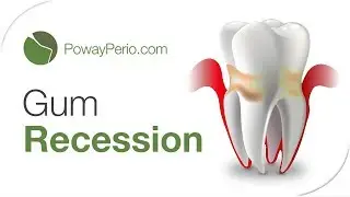 What is gum recession?