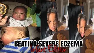 Battling Infancy Eczema! 2 year Aron Regimen Anniversary!