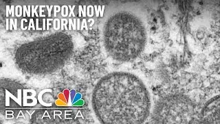 California Reports First Suspected Monkeypox Case in Sacramento County