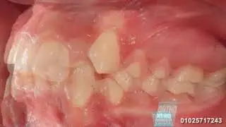 High canine leveling without extraction