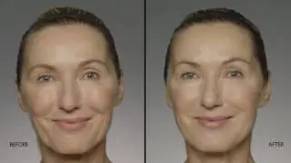 Restylane Refyne Arizona Dermacare
