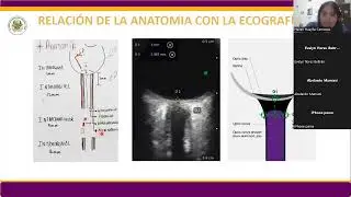 Ultrasonografía del Diametro de la Vaina del Nervio Óptico