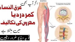 Sciatica patients Interview by Hakeem Rabnawaz Khan
