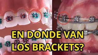 EN DONDE VAN LOS BRACKETS? Dr Leonel Santos