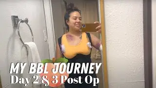 MY BBL SURGERY WITH DR. JUNG MONEY | MY BBL JOURNEY | DAY 2 & 3 POST OP | KRISTEN MARIE