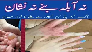 DIY Hand Burn Emergency Remedy | Instant Relief, No Blisters, No Scars