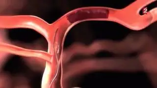 Un nouveau traitement r&eacute;volutionnaire des AVC