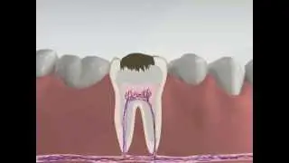3d Medical Animation - Root Canal