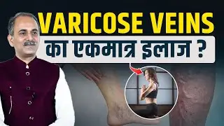 Varicose Veins Treatment | Ayurvedic remedies for Varicose veins | Acharya Manish Ji