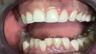 How to address severe teeth grinding on young adults