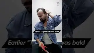 Youtuber Nadeem Bunny (Topa Bhai)  Eight Months Hair Transplant Result #shorts#hairtransplant