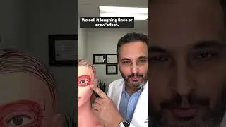 Botox treatment of Crow&rsquo;s feet, wrinkles around the eyes.
