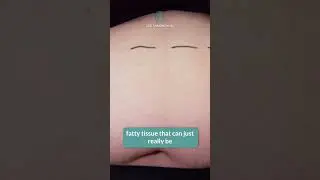 High BMI Tummy Tuck with Dr.LaBarbera