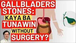 Gallbladders Stones: Kaya Ba Tunawin Without Surgery? - By Doc Willie Ong