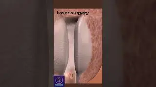 Prostate Laser Surgery #education #shorts