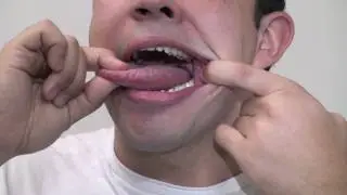 Autoexame Bucal