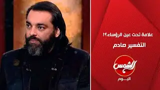 محمود صلاح يفسر سبب العلامة اللي بتظهر تحت عين رؤساء الأجانب… مش هتتوقع اللي قاله