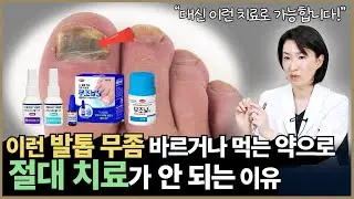 발톱 무좀, 먹는 약으로 절대 치료가 안 되는 이유? 대신 이렇게 치료 하세요!
