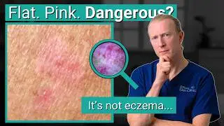 That Red Patch Might Be Skin Cancer | What Is Superficial BCC?