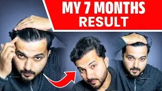 Hair Transplant Result After 7 And Half Months 🔥