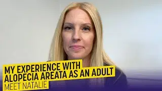 My experience with alopecia areata as an adult