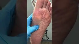 Cutaneous Horn Removal #footcare #footcare #houstonpodiatrist