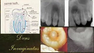 Dens Invaginatus| Disturbances in Shape| oral pathology 