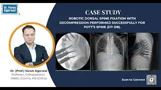 Robotic Dorsal Spine Fixation with Decompression (D3&ndash;D9)  | Dr. (Prof.) Varun Agarwal