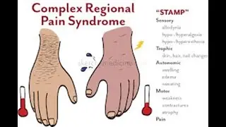Complex Regional Pain Syndrome CRPS; chronic pain condition usually develops after injury, surgery