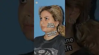 MINI FACELIFT for 36 Year Old Mother #antiaging #goviral #contour