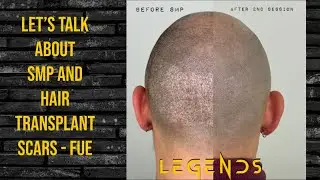 How does SMP work with hair transplant scars ( FUE )