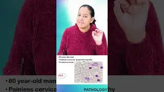 1 minute learning:  Chronic lymphocytic leukemia - CLL