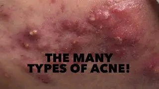 The Many Types of Acne