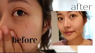 Getting my freckles removed in Korea: full process, price, healing, and tips