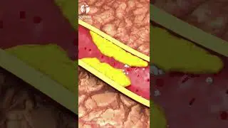 Infarctus du myocarde : Ce que tout le monde devrait savoir pour pr&eacute;venir
